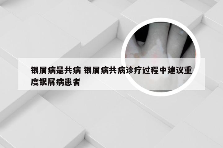 银屑病是共病 银屑病共病诊疗过程中建议重度银屑病患者