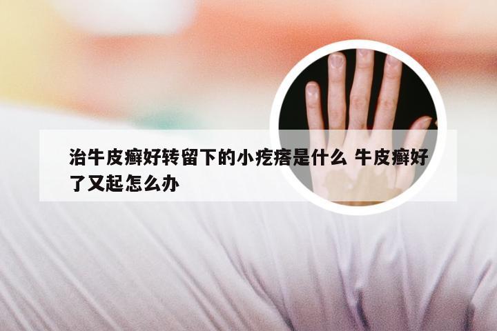治牛皮癣好转留下的小疙瘩是什么 牛皮癣好了又起怎么办