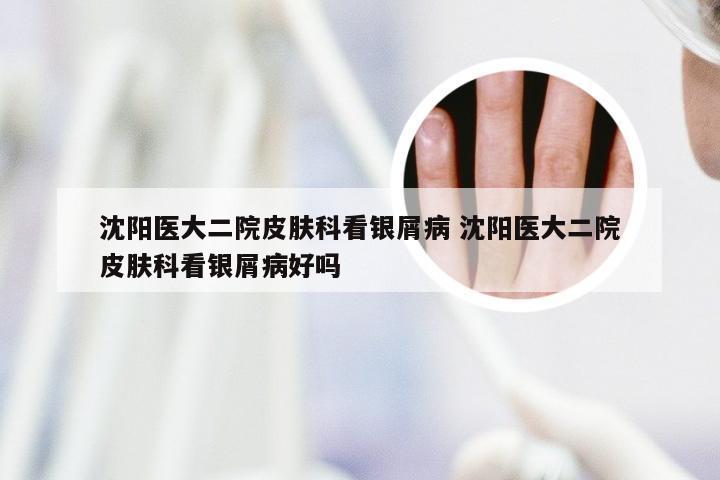 沈阳医大二院皮肤科看银屑病 沈阳医大二院皮肤科看银屑病好吗