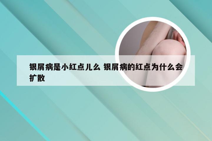 银屑病是小红点儿么 银屑病的红点为什么会扩散