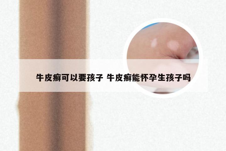 牛皮癣可以要孩子 牛皮癣能怀孕生孩子吗
