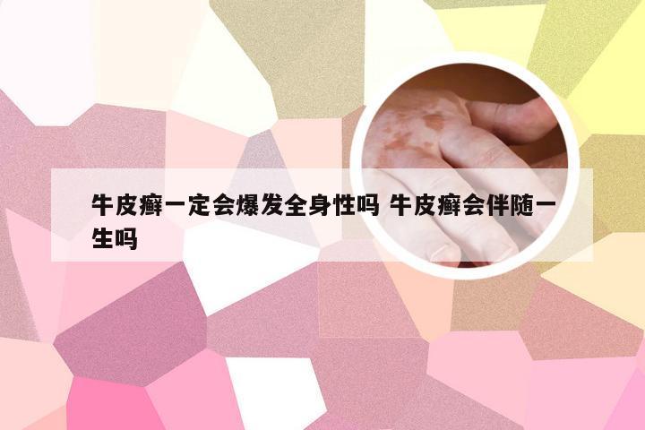 牛皮癣一定会爆发全身性吗 牛皮癣会伴随一生吗
