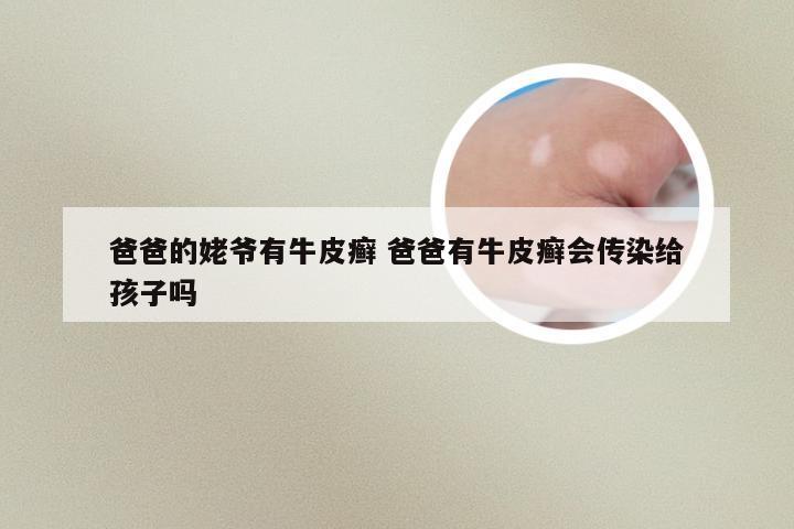 爸爸的姥爷有牛皮癣 爸爸有牛皮癣会传染给孩子吗