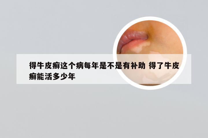 得牛皮癣这个病每年是不是有补助 得了牛皮癣能活多少年