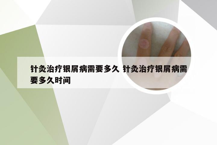 针灸治疗银屑病需要多久 针灸治疗银屑病需要多久时间