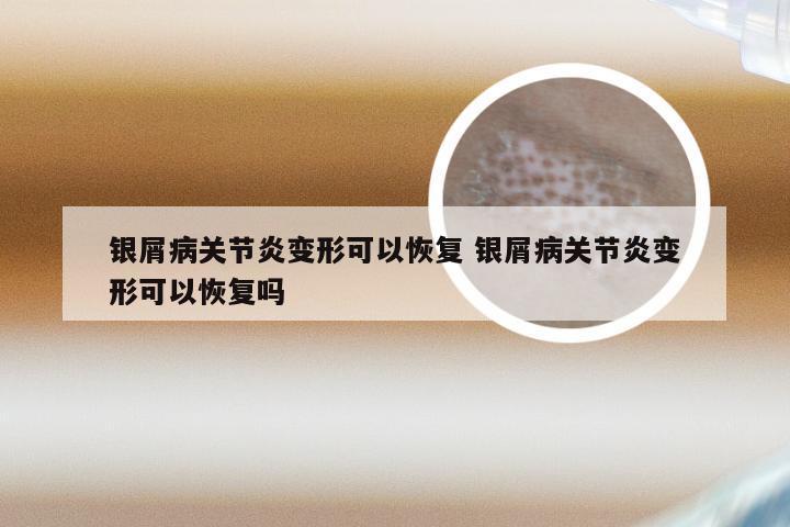 银屑病关节炎变形可以恢复 银屑病关节炎变形可以恢复吗