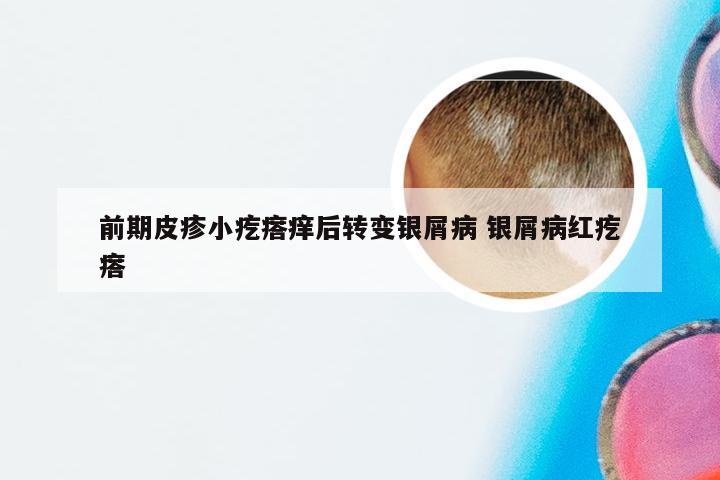 前期皮疹小疙瘩痒后转变银屑病 银屑病红疙瘩