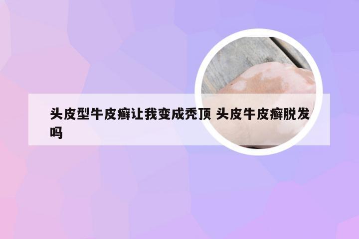 头皮型牛皮癣让我变成秃顶 头皮牛皮癣脱发吗