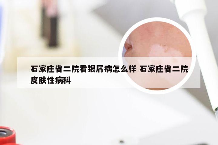 石家庄省二院看银屑病怎么样 石家庄省二院皮肤性病科