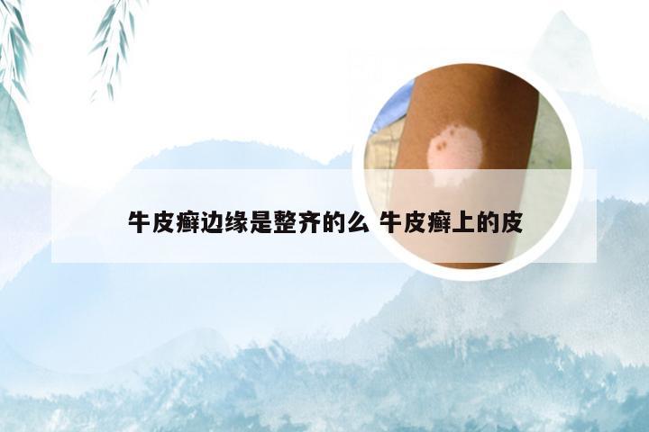 牛皮癣边缘是整齐的么 牛皮癣上的皮