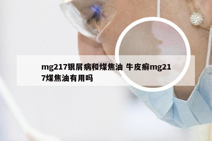 mg217银屑病和煤焦油 牛皮癣mg217煤焦油有用吗