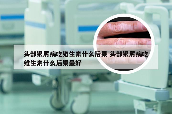 头部银屑病吃维生素什么后果 头部银屑病吃维生素什么后果最好