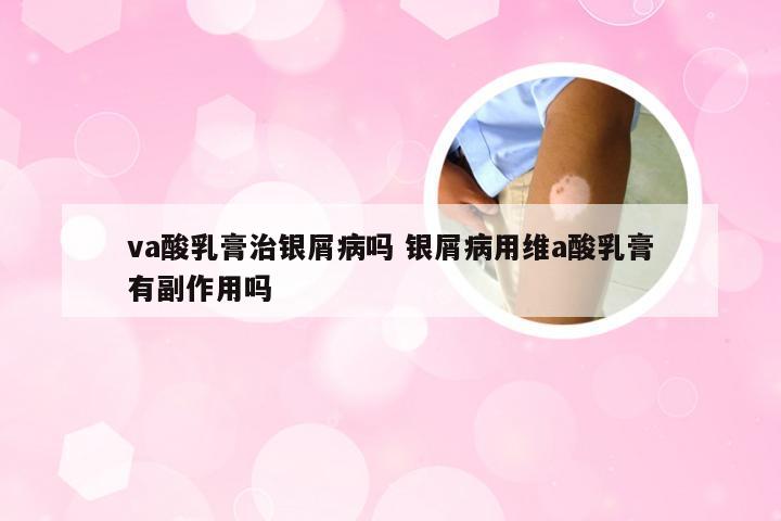 va酸乳膏治银屑病吗 银屑病用维a酸乳膏有副作用吗