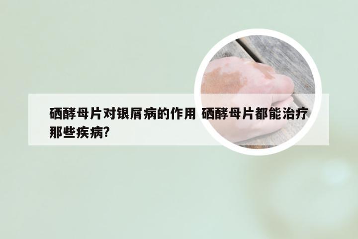 硒酵母片对银屑病的作用 硒酵母片都能治疗那些疾病?