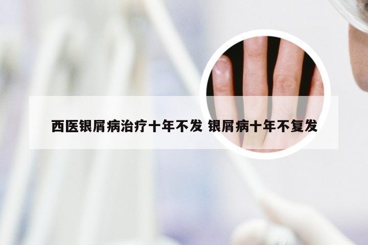 西医银屑病治疗十年不发 银屑病十年不复发