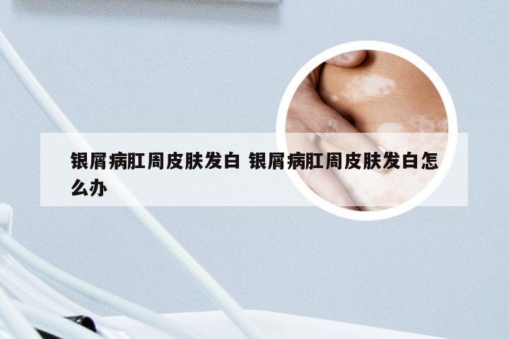 银屑病肛周皮肤发白 银屑病肛周皮肤发白怎么办