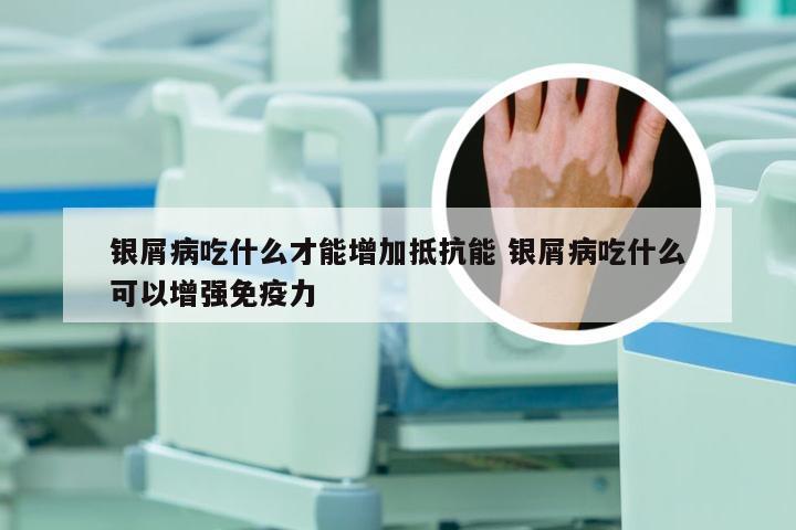 银屑病吃什么才能增加抵抗能 银屑病吃什么可以增强免疫力