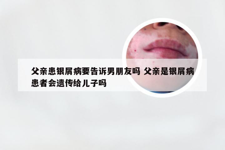 父亲患银屑病要告诉男朋友吗 父亲是银屑病患者会遗传给儿子吗