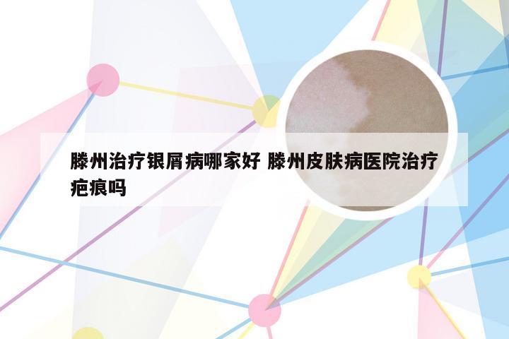 滕州治疗银屑病哪家好 滕州皮肤病医院治疗疤痕吗