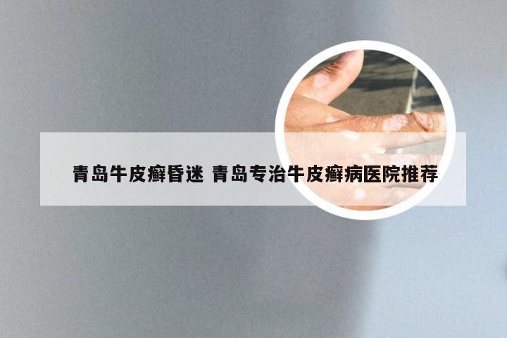 青岛牛皮癣昏迷 青岛专治牛皮癣病医院推荐