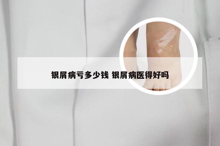 银屑病亏多少钱 银屑病医得好吗