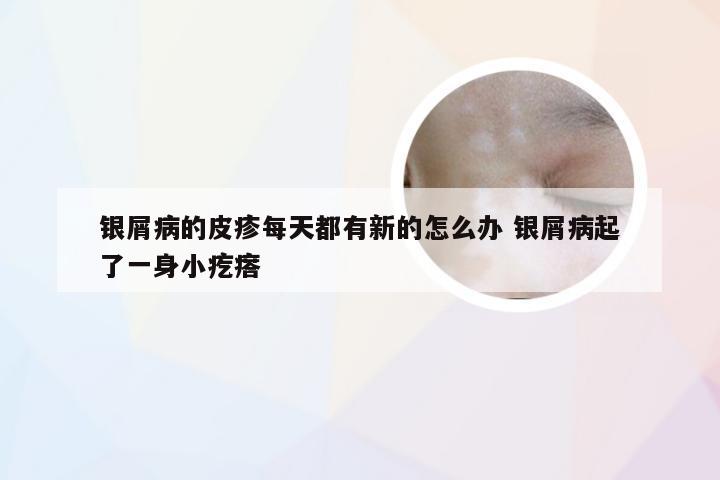 银屑病的皮疹每天都有新的怎么办 银屑病起了一身小疙瘩