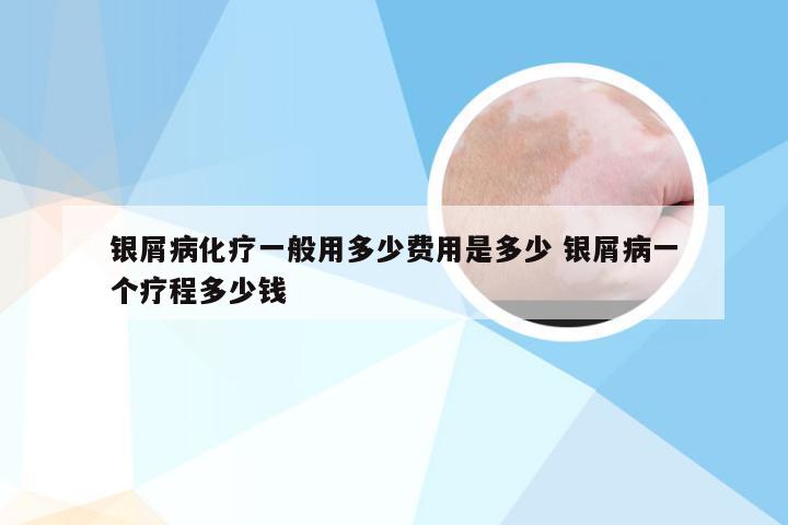 银屑病化疗一般用多少费用是多少 银屑病一个疗程多少钱