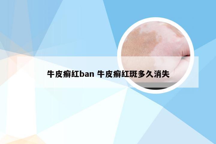 牛皮癣红ban 牛皮癣红斑多久消失