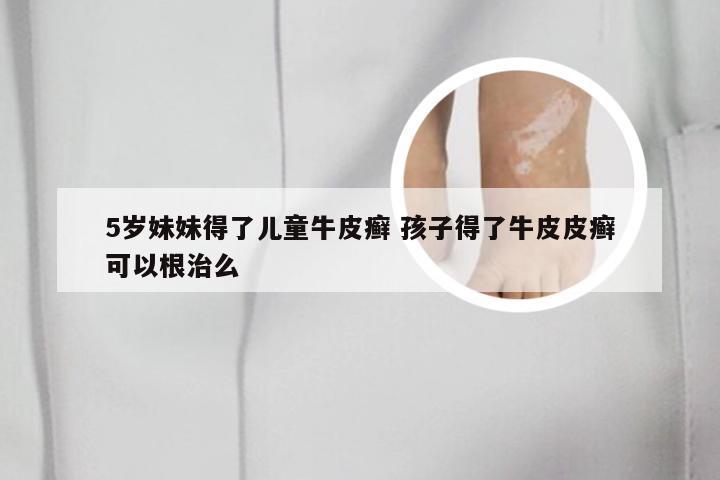 5岁妹妹得了儿童牛皮癣 孩子得了牛皮皮癣可以根治么