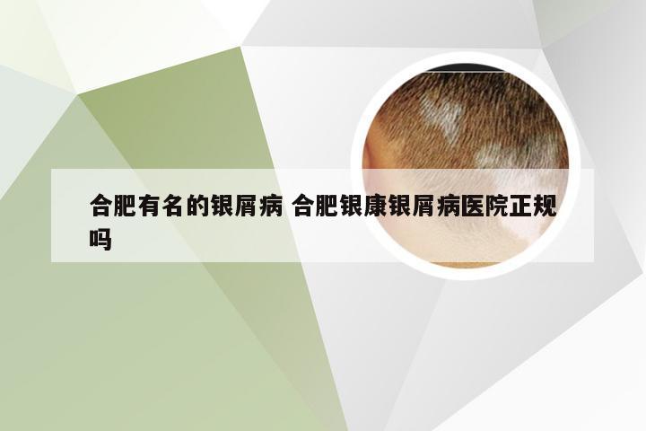合肥有名的银屑病 合肥银康银屑病医院正规吗