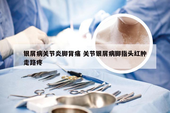 银屑病关节炎脚背痛 关节银屑病脚指头红肿走路疼
