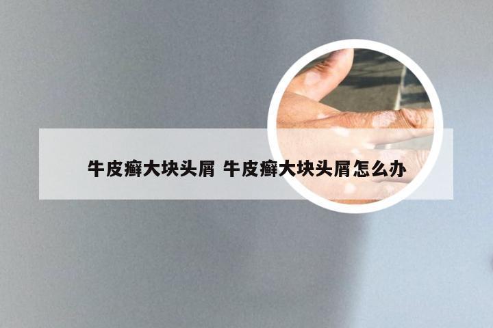 牛皮癣大块头屑 牛皮癣大块头屑怎么办