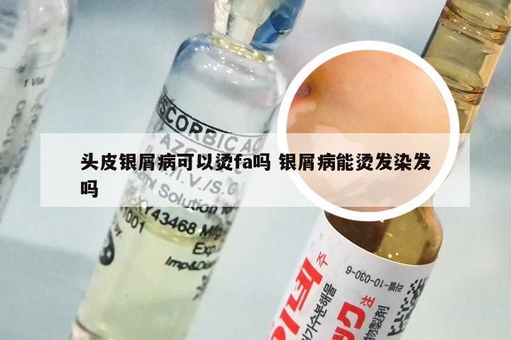 头皮银屑病可以烫fa吗 银屑病能烫发染发吗