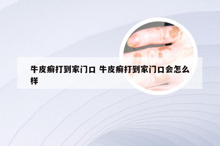 牛皮癣打到家门口 牛皮癣打到家门口会怎么样