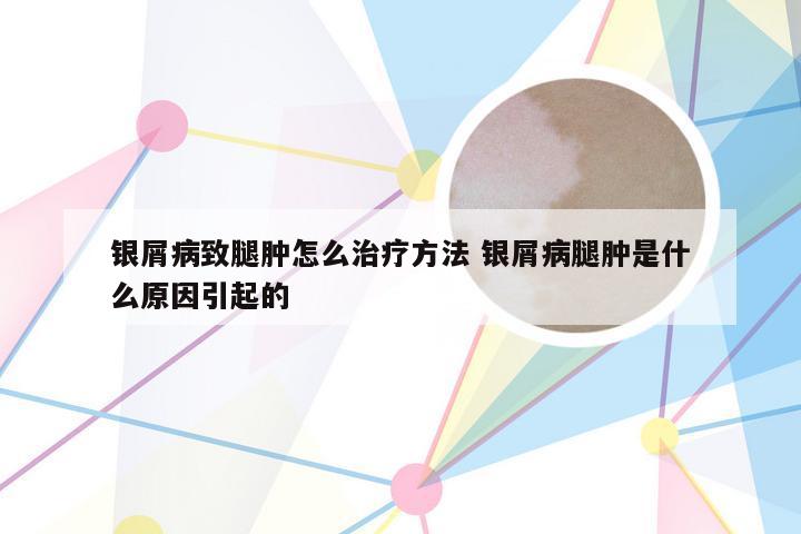 银屑病致腿肿怎么治疗方法 银屑病腿肿是什么原因引起的