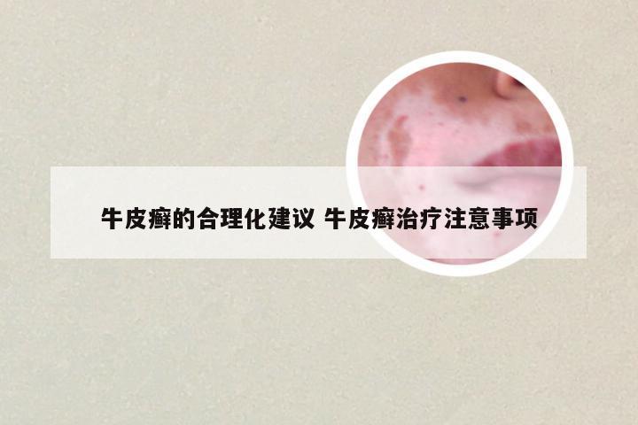 牛皮癣的合理化建议 牛皮癣治疗注意事项