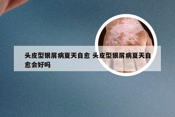 头皮型银屑病夏天自愈 头皮型银屑病夏天自愈会好吗