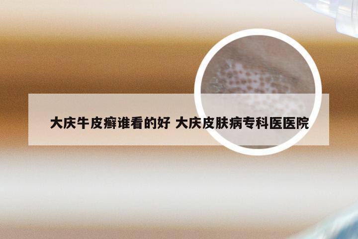 大庆牛皮癣谁看的好 大庆皮肤病专科医医院