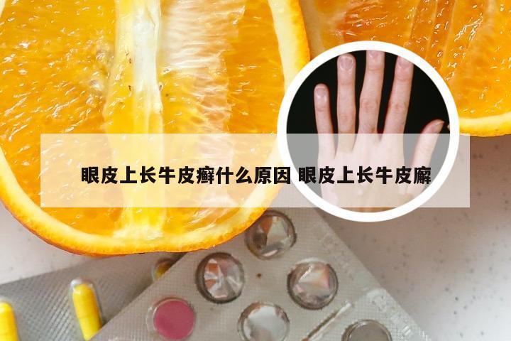 眼皮上长牛皮癣什么原因 眼皮上长牛皮廨