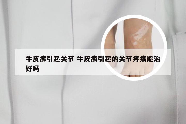 牛皮癣引起关节 牛皮癣引起的关节疼痛能治好吗
