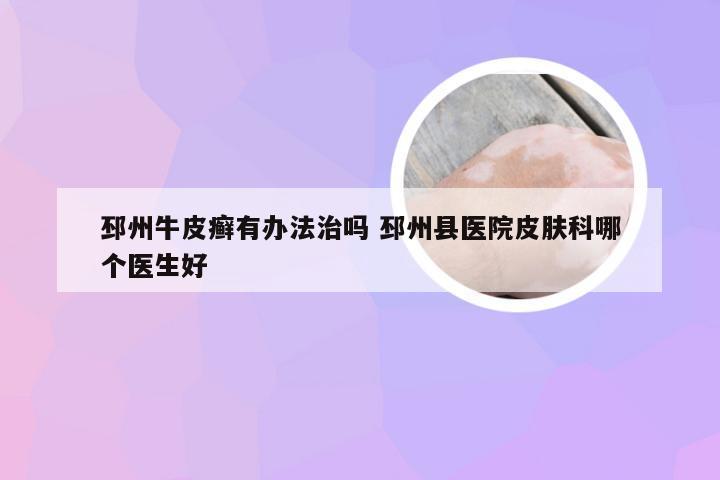 邳州牛皮癣有办法治吗 邳州县医院皮肤科哪个医生好