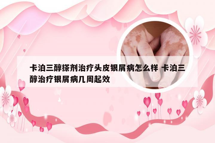 卡泊三醇搽剂治疗头皮银屑病怎么样 卡泊三醇治疗银屑病几周起效