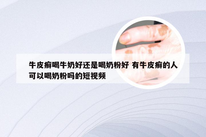 牛皮癣喝牛奶好还是喝奶粉好 有牛皮癣的人可以喝奶粉吗的短视频