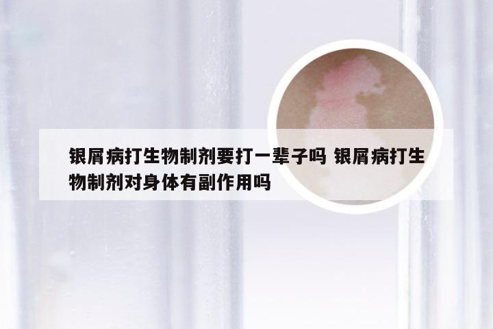 银屑病打生物制剂要打一辈子吗 银屑病打生物制剂对身体有副作用吗