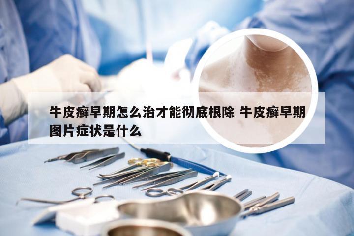 牛皮癣早期怎么治才能彻底根除 牛皮癣早期图片症状是什么