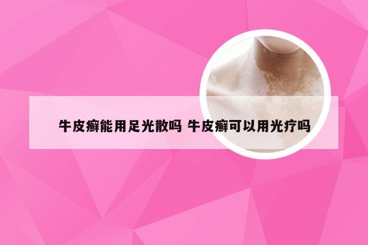 牛皮癣能用足光散吗 牛皮癣可以用光疗吗
