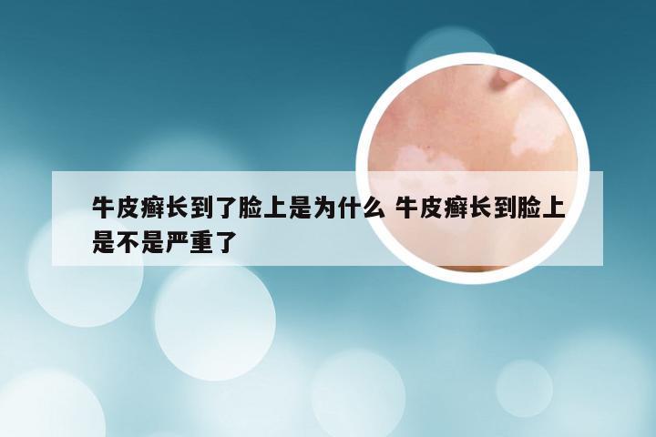 牛皮癣长到了脸上是为什么 牛皮癣长到脸上是不是严重了