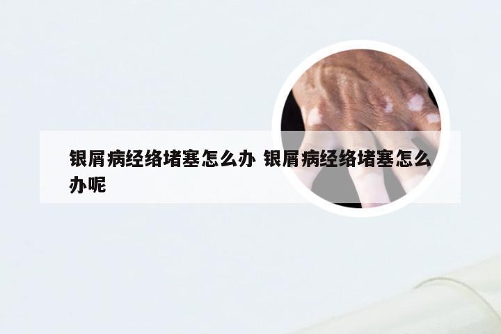 银屑病经络堵塞怎么办 银屑病经络堵塞怎么办呢