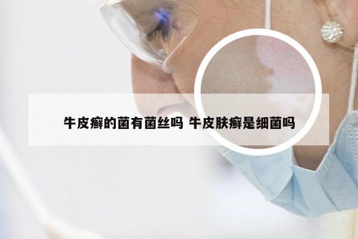 牛皮癣的菌有菌丝吗 牛皮肤癣是细菌吗
