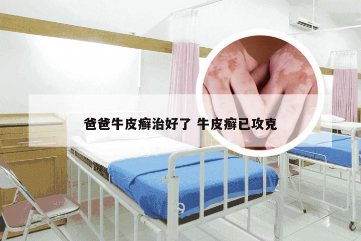 爸爸牛皮癣治好了 牛皮癣已攻克